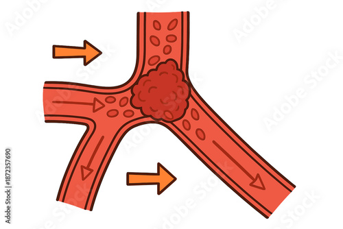 Blood vessel image showing blockage causing disruption in flow and highlighting the importance of circulation