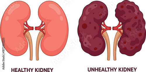 Healthy and unhealthy kidney comparison, medical anatomy, disease awareness, organ health concept, flat vector illustration, educational healthcare graphic