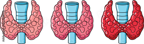 Thyroid gland anatomy illustration set showing normal and diseased thyroid conditions, endocrine health and medical education concept