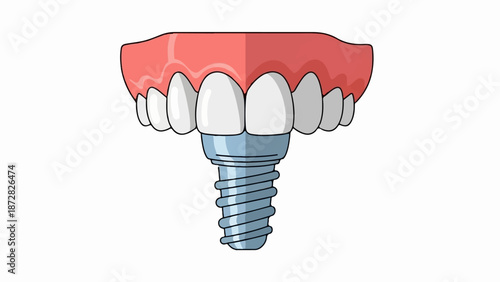 Cartoon dental implant with white teeth and pink gums