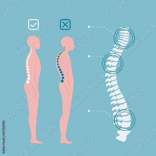 Educational poster with different types of scoliosis. Hyperkyphosis, osteogenesis.Disorders of musculoskeletal system. Example of scoliosis of varying degrees. Spinal curvature