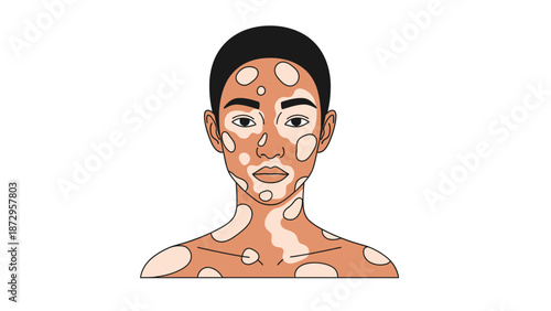 Portrait of a Woman with Vitiligo Skin Condition Illustration.