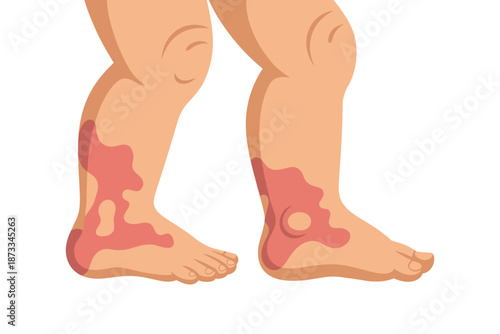 An illustration of a person's legs with skin lesions and eczema