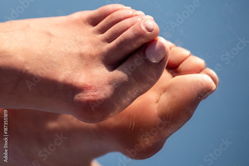 Tableau sur toile Hallux valgus deformity of big toe joint