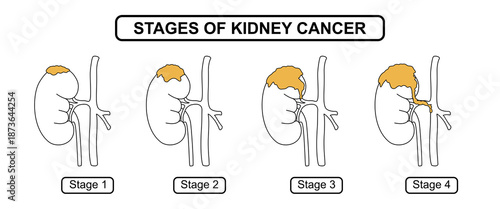 Illustration of the stage of kidney cancer. The development of cancer in human kidney, problems in the urinary system. Vector line drawing illustration for education, medical, clinic and science.