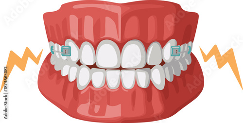 Dental Braces on Human Teeth Vector Illustration for Orthodontic Treatment Healthcare Stomatology Dentist Clinic Oral Hygiene and Medical Health Concept