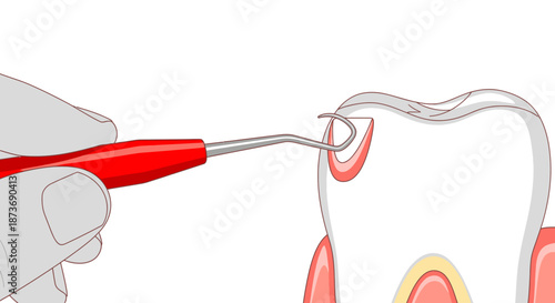 A close-up illustration of a dental professional using a probe to examine a tooth with an existing filling or potential cavity, highlighting oral health.