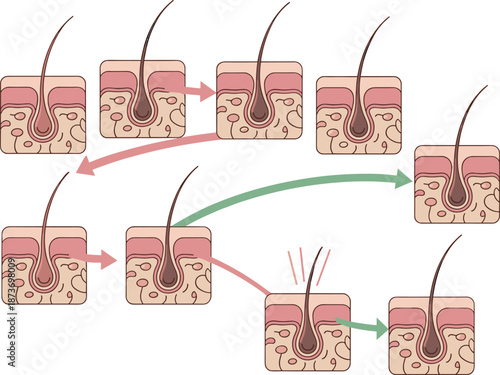 Medical illustration of human hair growth cycle phases showing follicle development within skin layers for dermatology education and scientific research