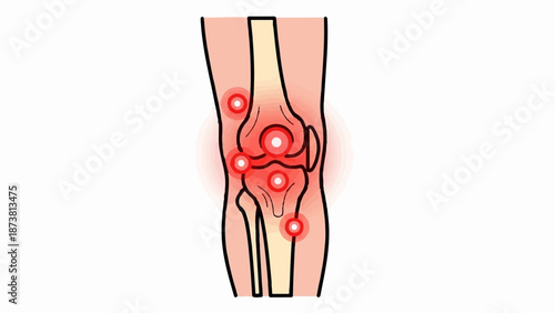 Diagram of a human knee joint showing areas of pain