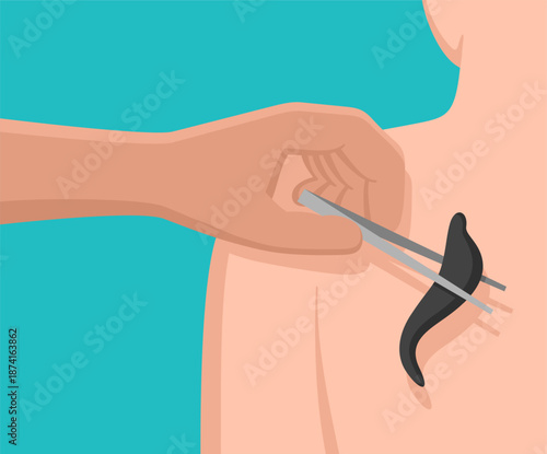 Hirudotherapy treatment with medical leech application