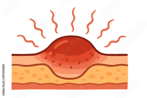 Illustration of a red bump on skin with layers and heat lines in a simple style showing irritation or inflammation