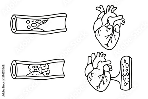 Heart and blood vessel illustrations showing healthy and unhealthy conditions with labeled parts and stages of blockage