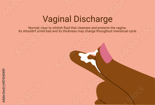 Vaginal discharge symptoms, medical concept of yeast infection, bacterial vaginosis and female reproductive health. Abnormal discharge vector illustration