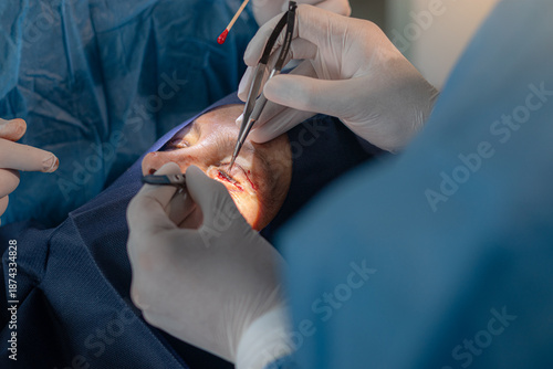 Bild auf Leinwand Extreme close-up of a surgeon using metal forceps to delicate hold and manipulate the eyelid skin of a patient during a blepharoplasty surgery, revealing the open incision