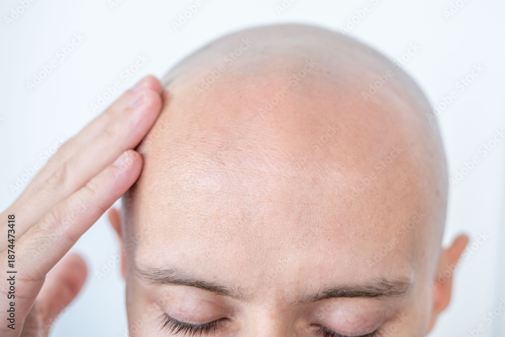 Fototapeta premium Young Bald man touching his head, eyes closed, bald patches on scalp, showing signs alopecia, healing touch, treatment hair loss, personal moment, stress relief