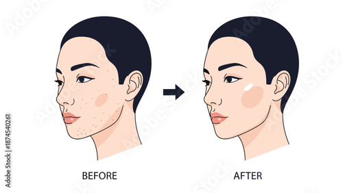 Side profile comparison of a woman's face showing skin before and after acne treatment with clear and glowing results on the cheek.