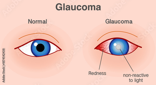 Glaucoma eye, optic nerve of the eye is damaged. Severe headache,  redness, blurred or decreased vision. Blue eye, skin color back. Illustration vector 