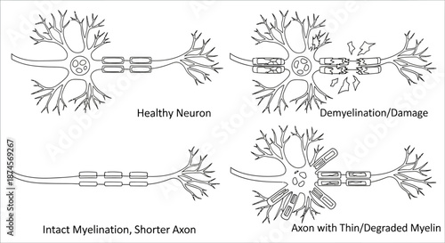 Detailed diagram illustrating the structural integrity and progressive degradation of myelin sheaths around neural axons, crucial for understanding nervous system health and disease mechanisms