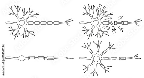 Comprehensive scientific illustration of various neuron structures, nerve cells, and neurological pathways, including healthy and damaged myelin sheaths, essential for understanding neurobiology