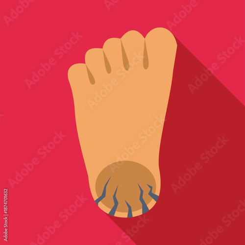 Foot showing severe cracking on the heel, indicating a dry skin condition