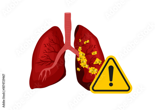 Human Lung Cancer Health Warning Disease Stock Illustration