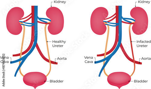 Comparison of Healthy and Infected Urinary System with Ureter Infection