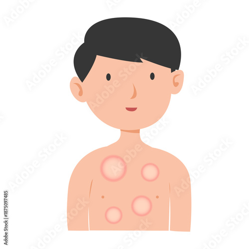 leprosy disease concept. vector illustration
