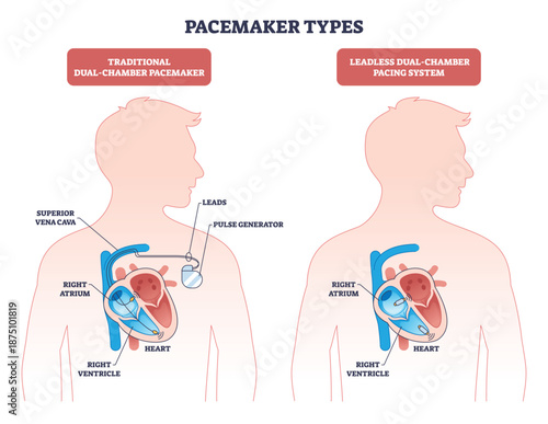 Pacemaker types overview compares traditional dual-chamber and leadless devices, highlighting heart, leads, and pulse generator placements. Outline diagram