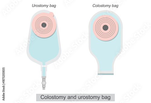 Colostomy and urostomy bag on abdomen isolated on white background.