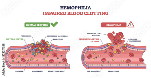 Hemophilia impaired clotting concept compares normal vs deficient repair in a blood vessel, highlighting platelets, red blood cells, and missing clotting factors causing bleeding. Outline diagram