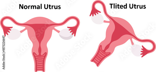 Vector illustration of a normal and a tilted uterus anatomy for educational purposes. Perfect for health education, medical presentations, and anatomy studies.