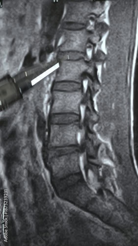 Vertical footage of x-ray with hernia in human spine. Close up view.