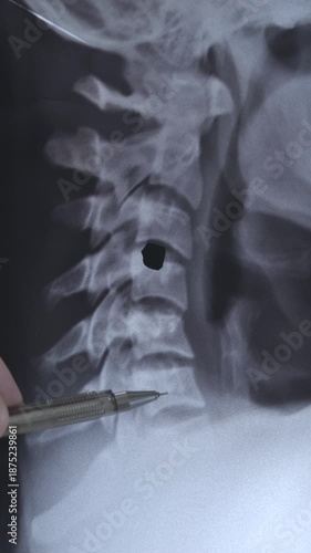 Vertical x-ray of tumor in vertebrae human cervical spine.