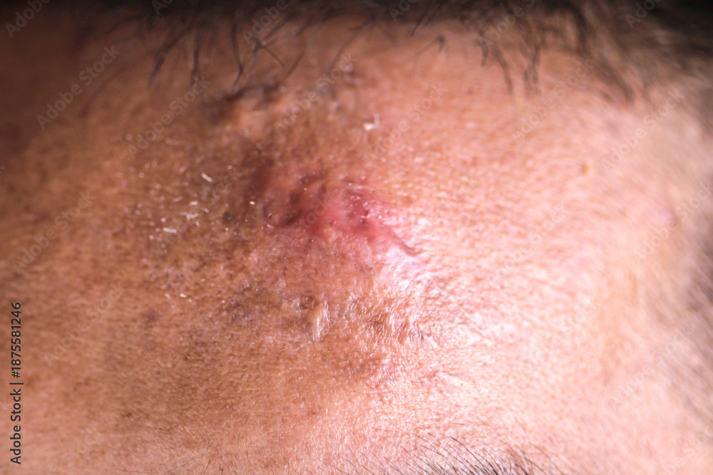 Fototapeta premium Close-Up of Skin Imperfection on Forehead with Healing Scabs