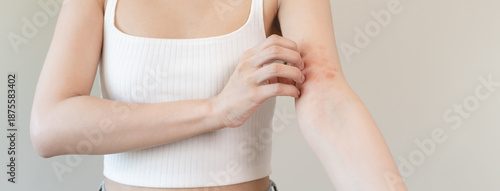 Fotografie Sensitive skin allergic concept, Woman itching on her arm have a red rash from allergy symptom and from scratching