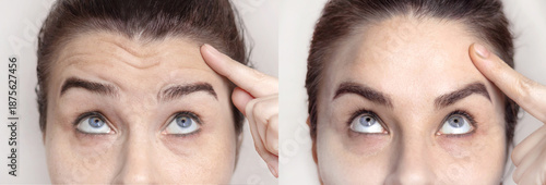 Φωτογραφία Collage with portraits Caucasian woman with wrinkles on the forehead and between her nose and portrait after visiting a beautician
