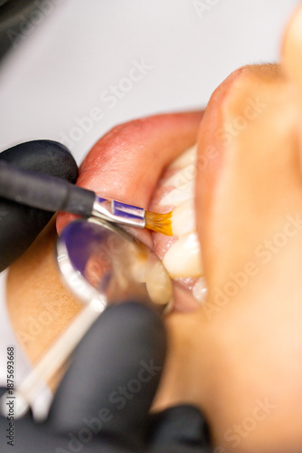 Dental professional applying tooth treatment in clinic