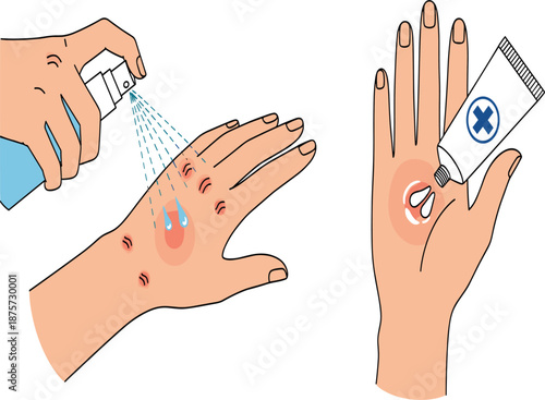 Hand wound care illustration, disinfectant spray, medical ointment application, skin injury treatment, first aid procedure, healthcare concept, injury healing process