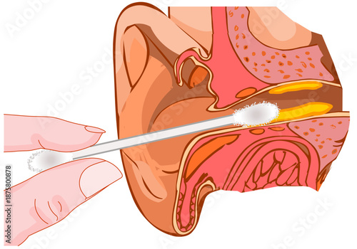 Ear cleaning cotton swab. Earwax removal. Cross section. Illustration vector.