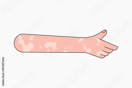Vitiligo thumbs up hand, gesture collage element vector