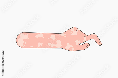 White vitiligo hand gesture, flat collage element vector