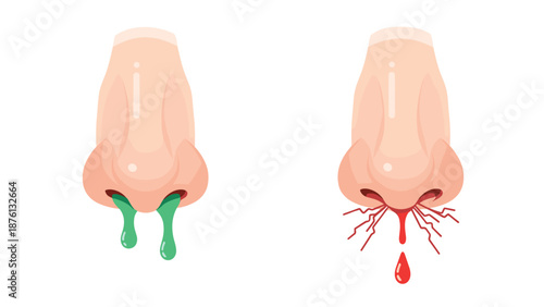 Anatomical comparison of two noses showing a runny nose with green mucus and a nosebleed with red blood drops on a white background.