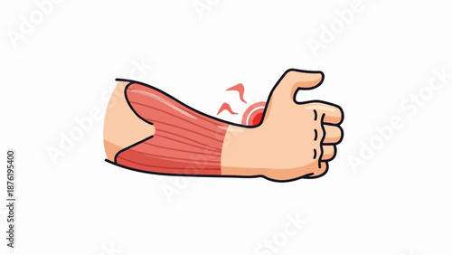 Stylized illustration of a hand with visible forearm muscles and a painful thumb area