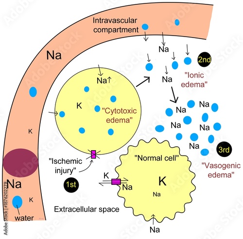 The ischemic processes during blockage of artery supplying the neurons.