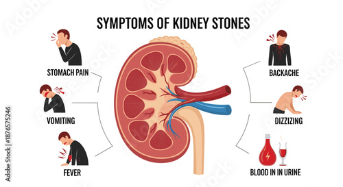 Informative medical infographic showing symptoms of kidney stones including stomach pain, vomiting, fever, and backache.