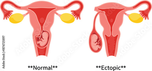 Medical vector illustration comparing a normal uterine pregnancy and an ectopic pregnancy in the fallopian tube for education.