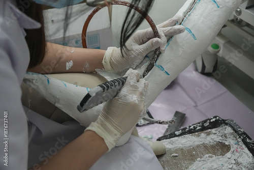 Orthotic fabrication process showing a specialist cutting and opening a plaster mold for a custom ankle foot orthosis (AFO). Close-up view highlighting precision work and assistive device production.