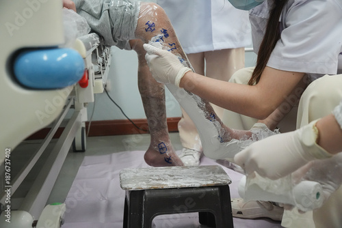 Orthotic fabrication process showing a specialist shaping a lower leg mold for a custom ankle foot orthosis (AFO). Clinical workspace scene focused on precision, care, and assistive device production.