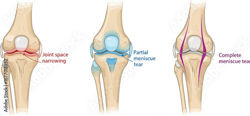 Knee Joint Anatomy Medical Diagram Showing Joint Space Narrowing and Meniscus Tear Types, Orthopedic Healthcare Illustration Vector