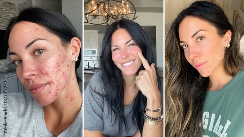Transformation Journey of Woman with Acne, Skin Care, and Confidence